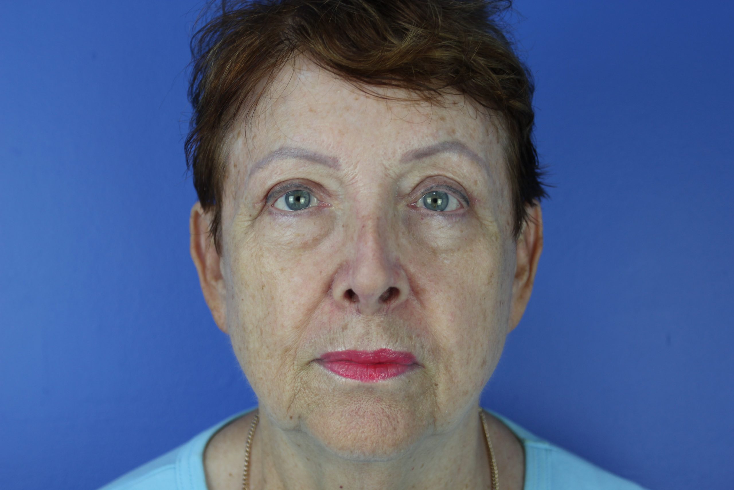 Blepharoplasty 6 weeks after anterior