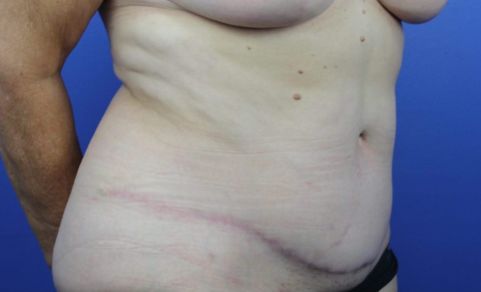 After breasts, abdomen R oblique