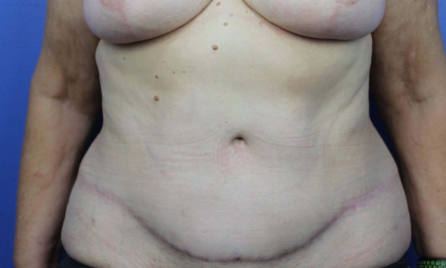 After breasts, abdomen anterior