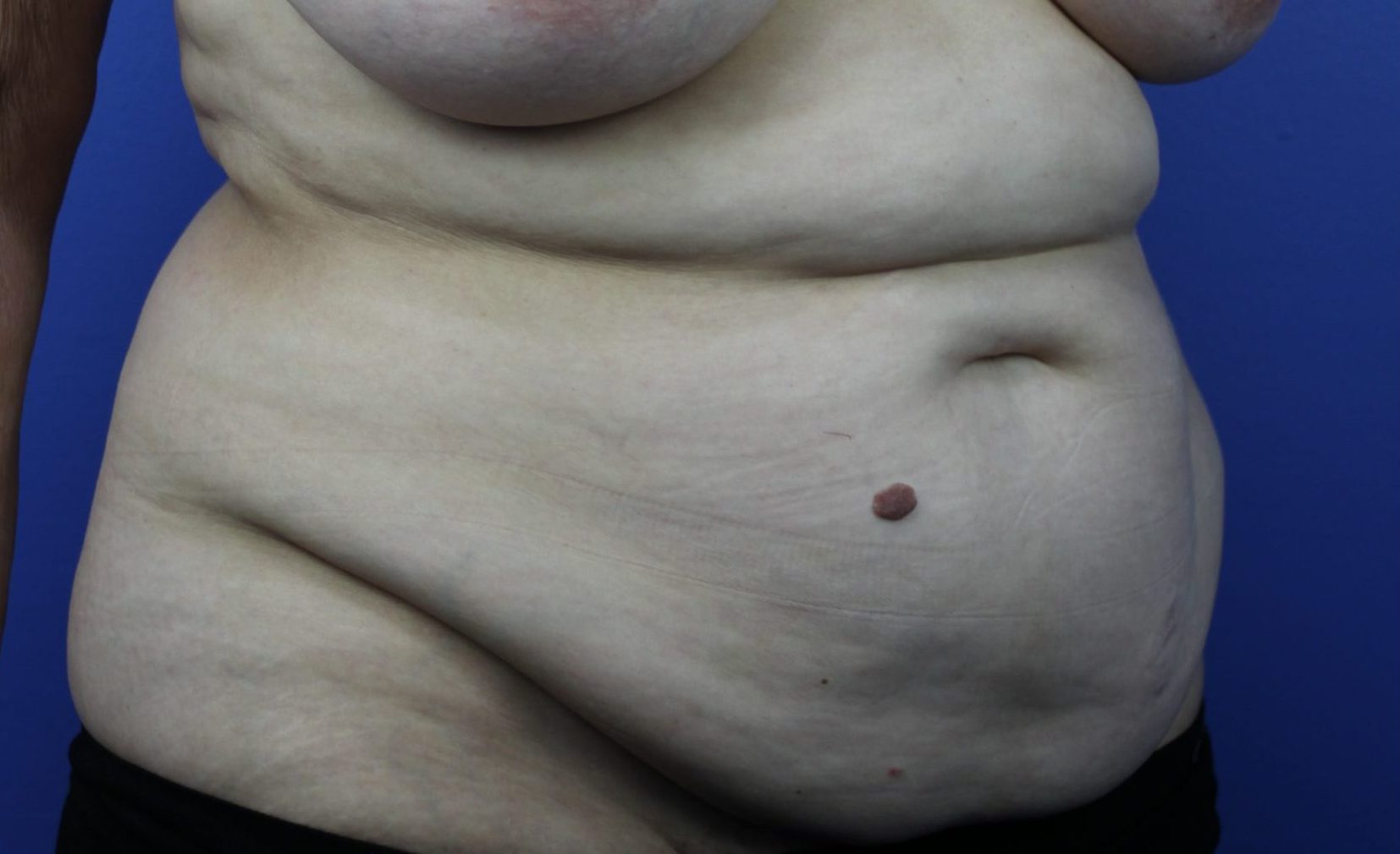 Before Breasts, Abdomen R Oblique