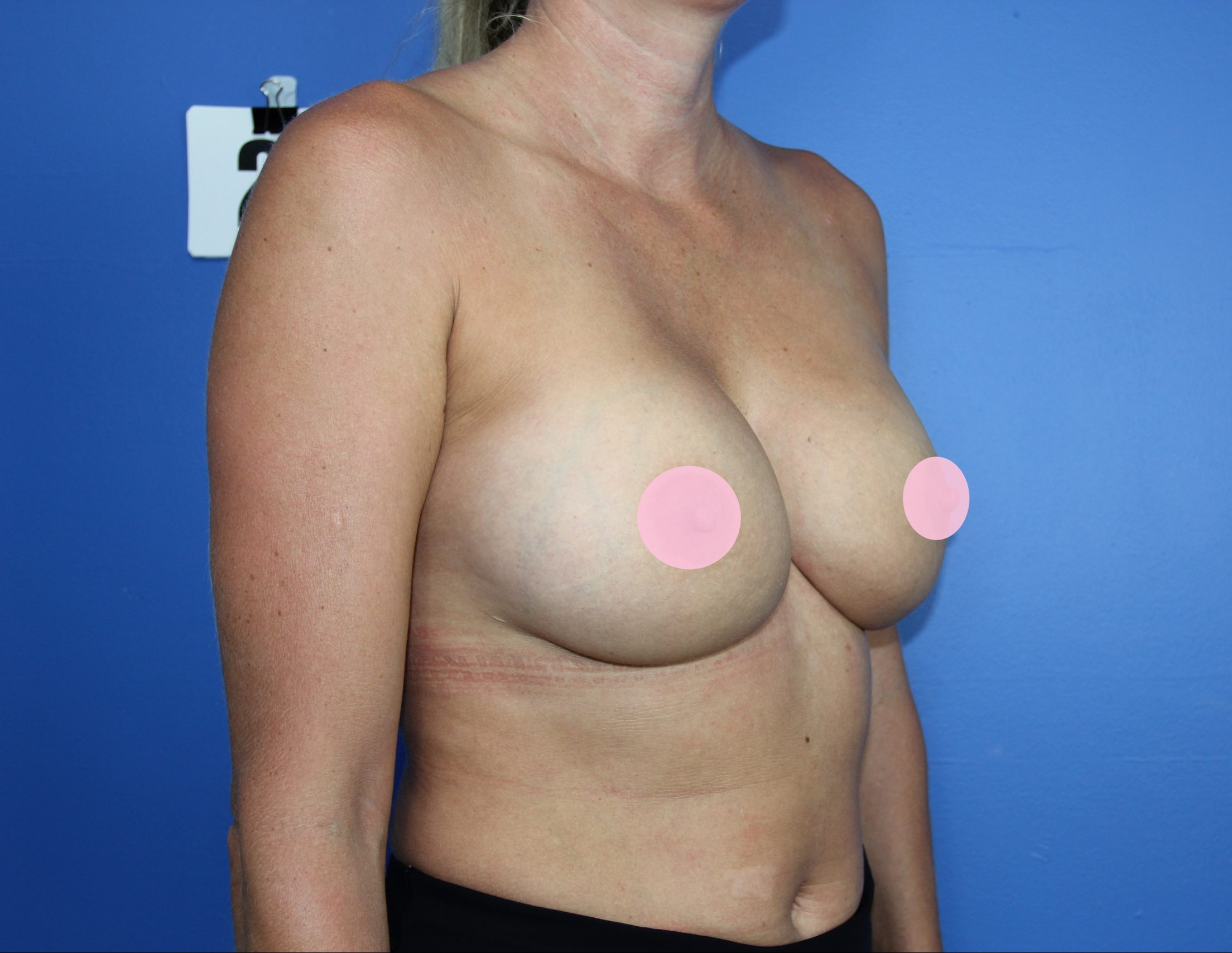 After-breasts-R-oblique-2