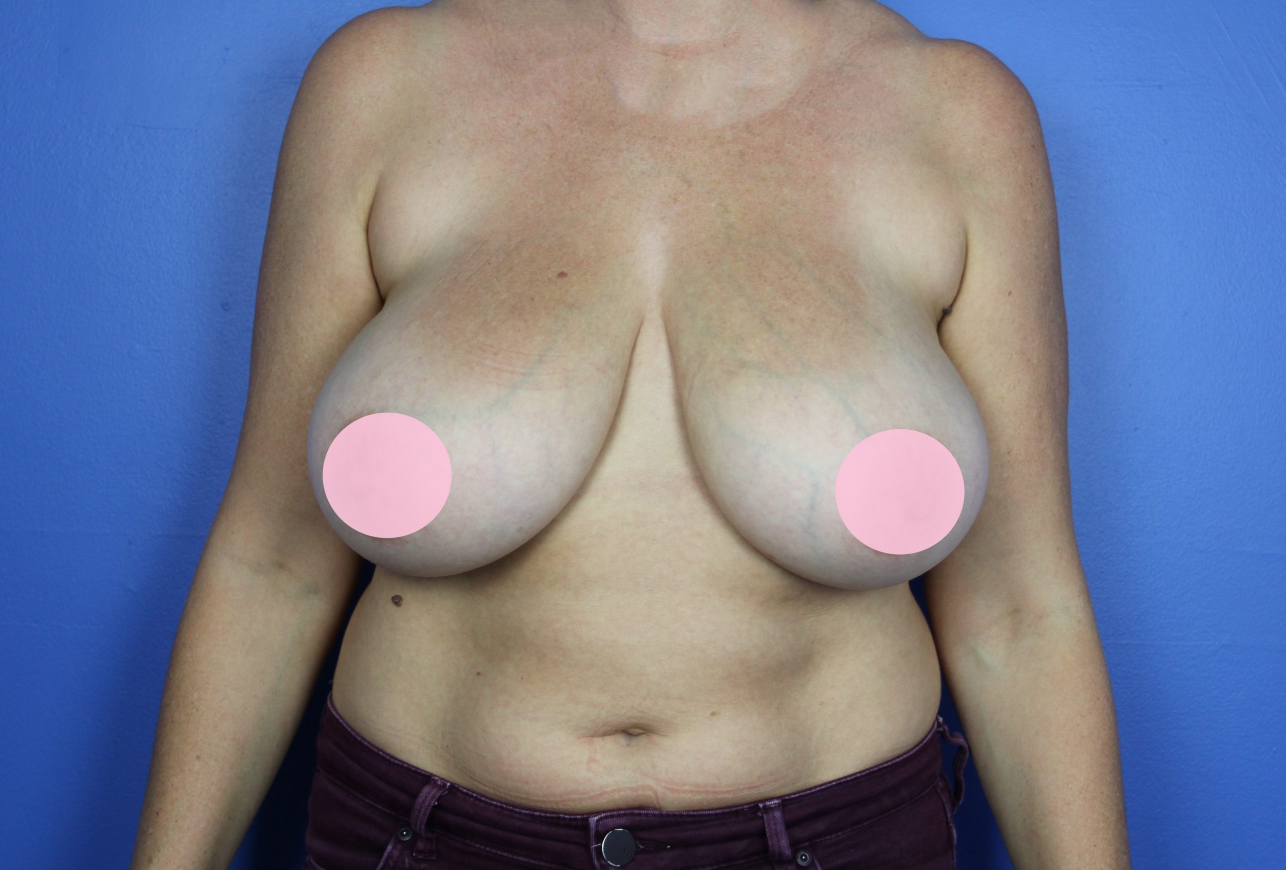 BBR-3-before-anterior-1