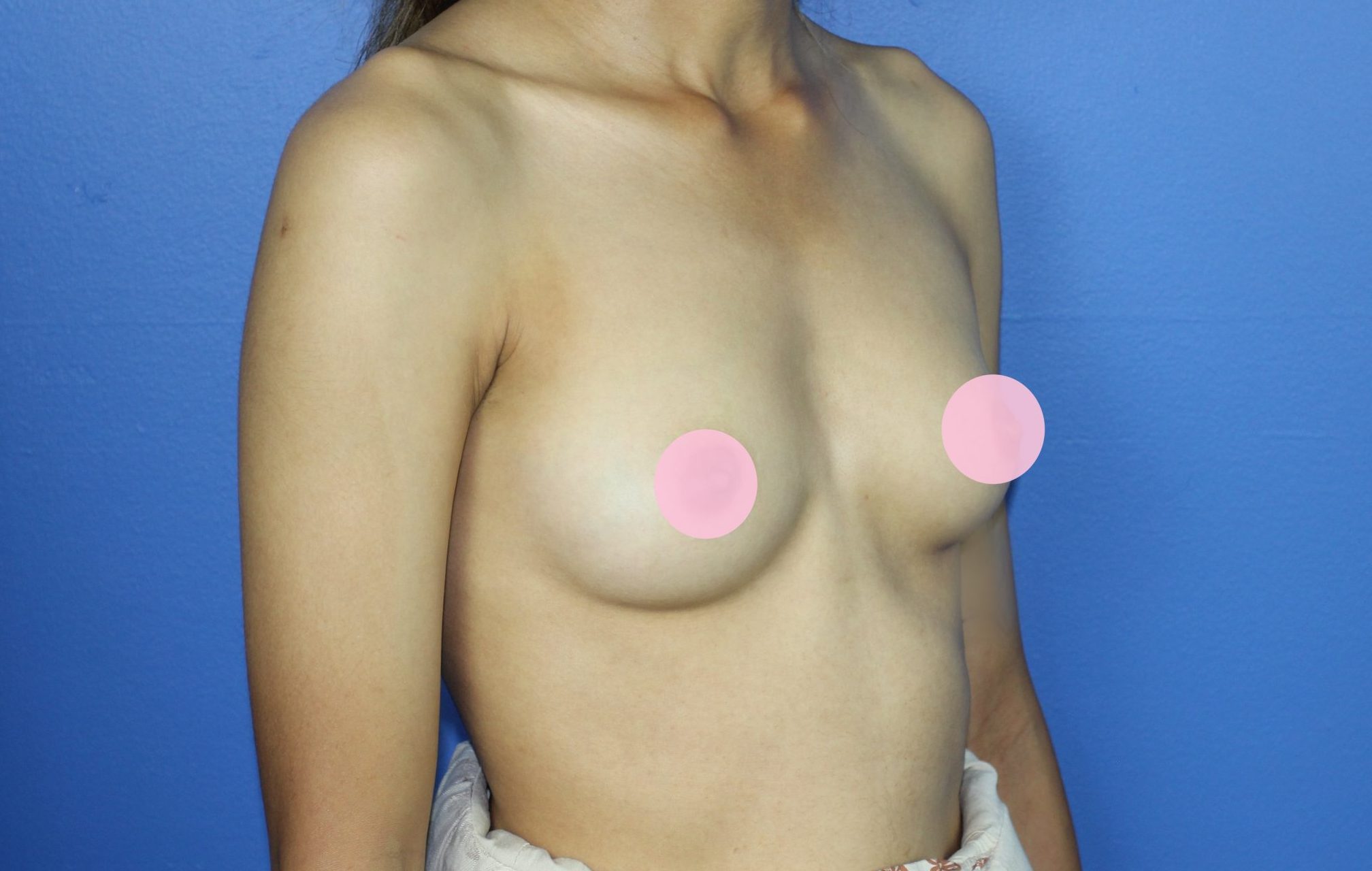 Before-breasts-R-oblique-1