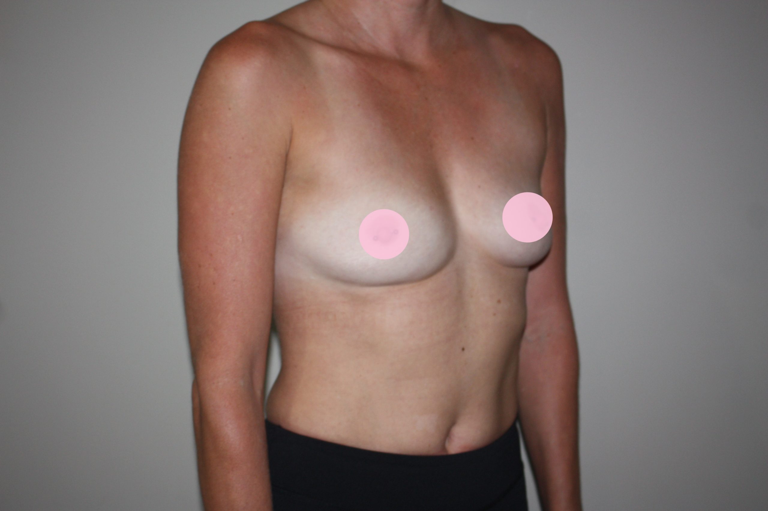 Before-breasts-R-oblique-2