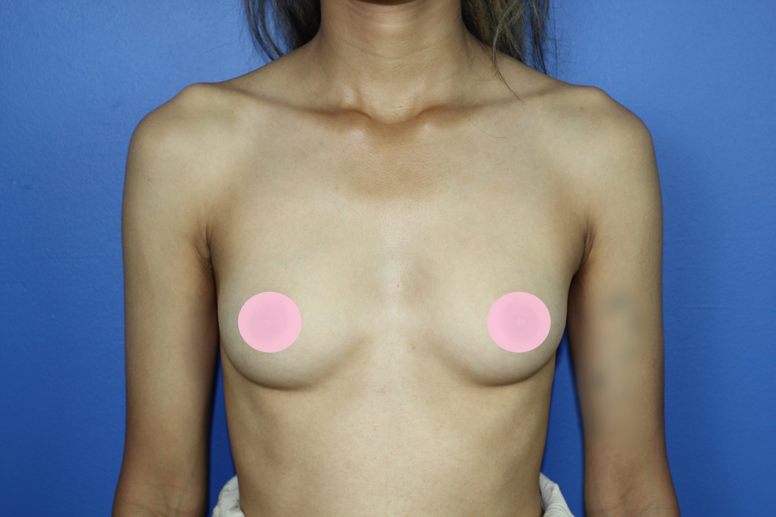 Before-breasts-anterior-1