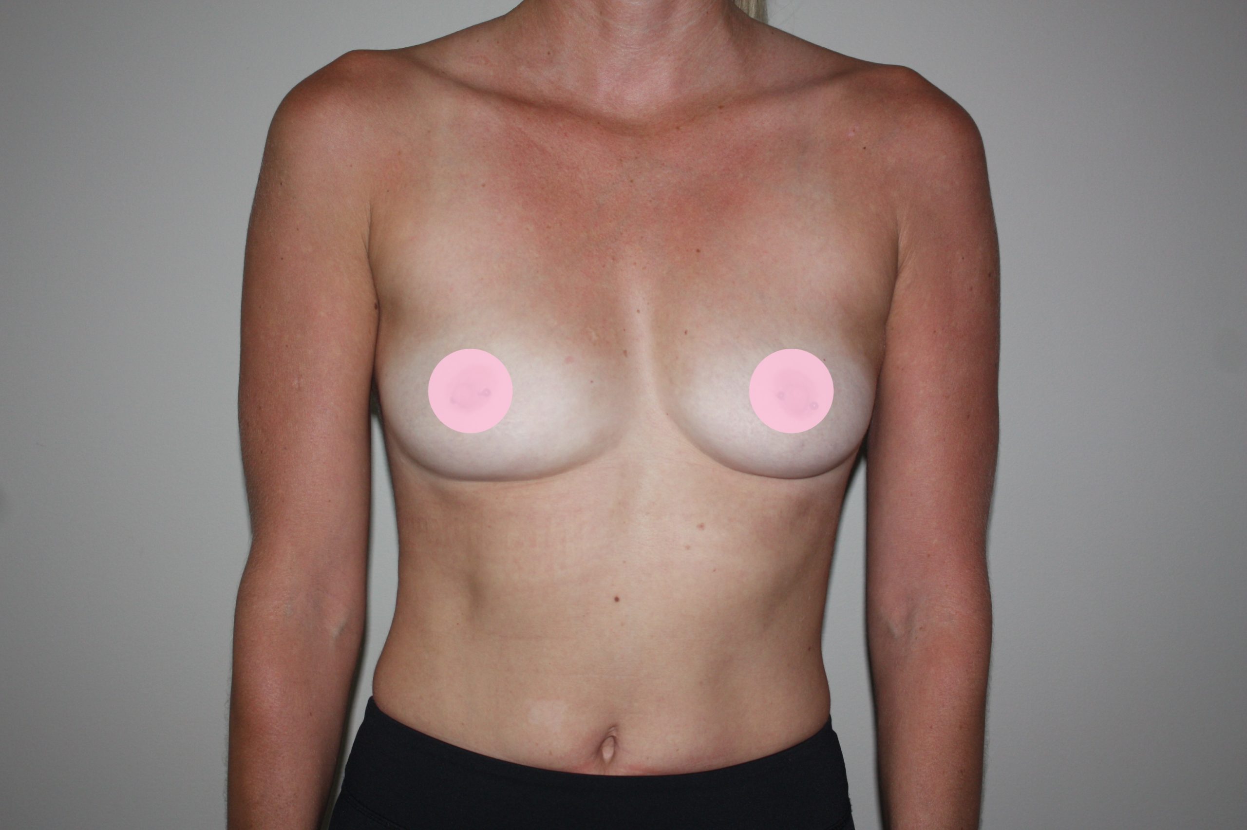 Before-breasts-anterior-2