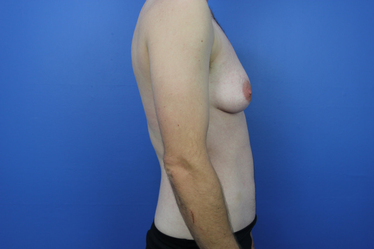 Breast R