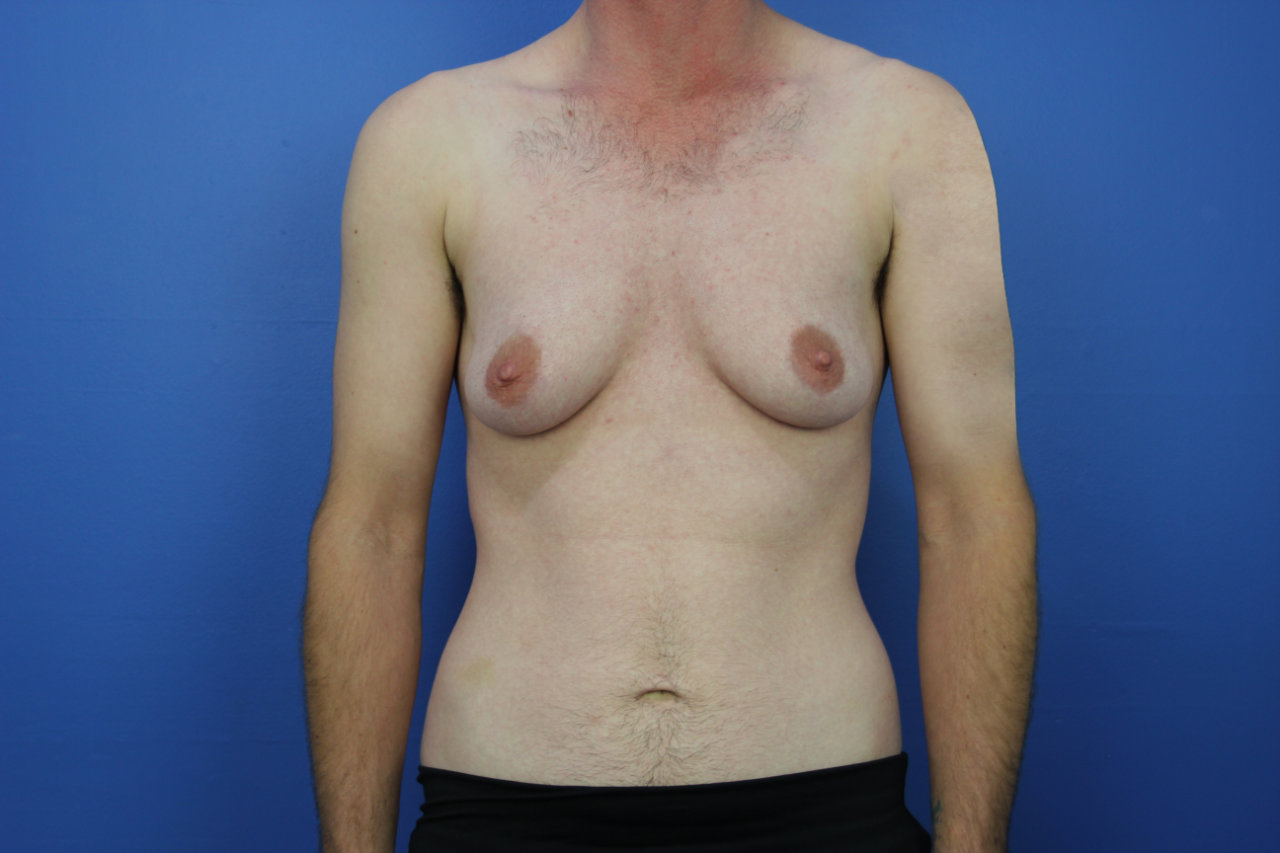Breast anterior