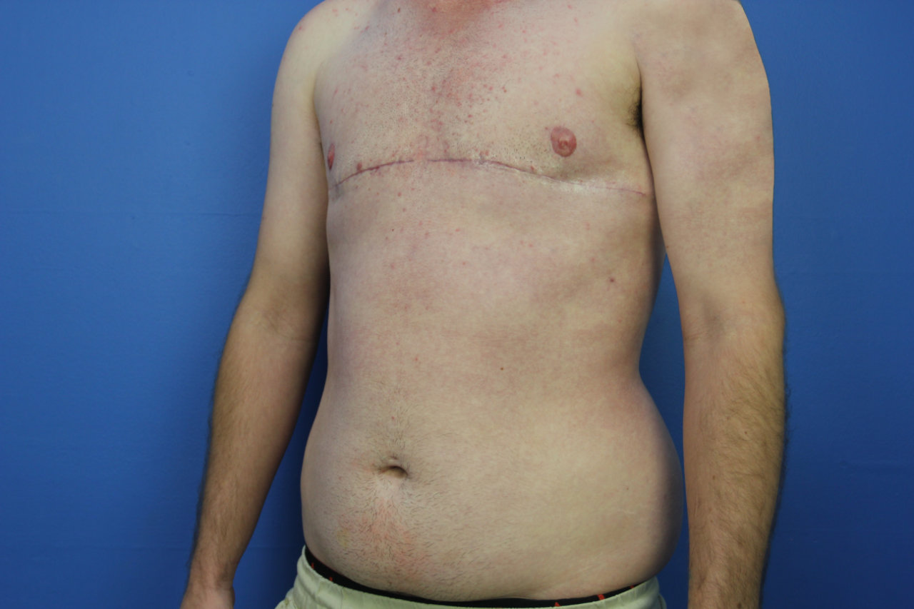 Chest L oblique
