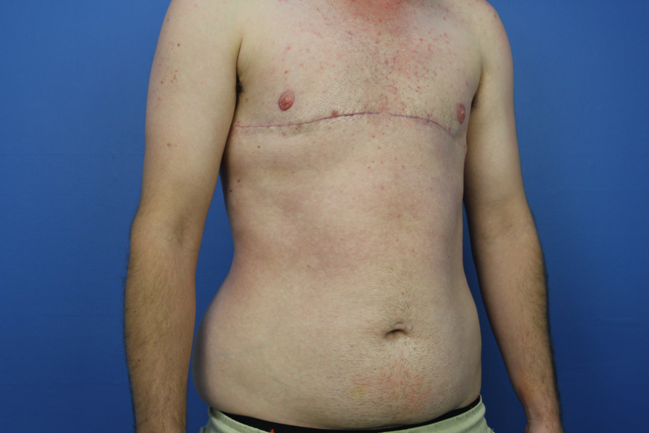 Chest R oblique