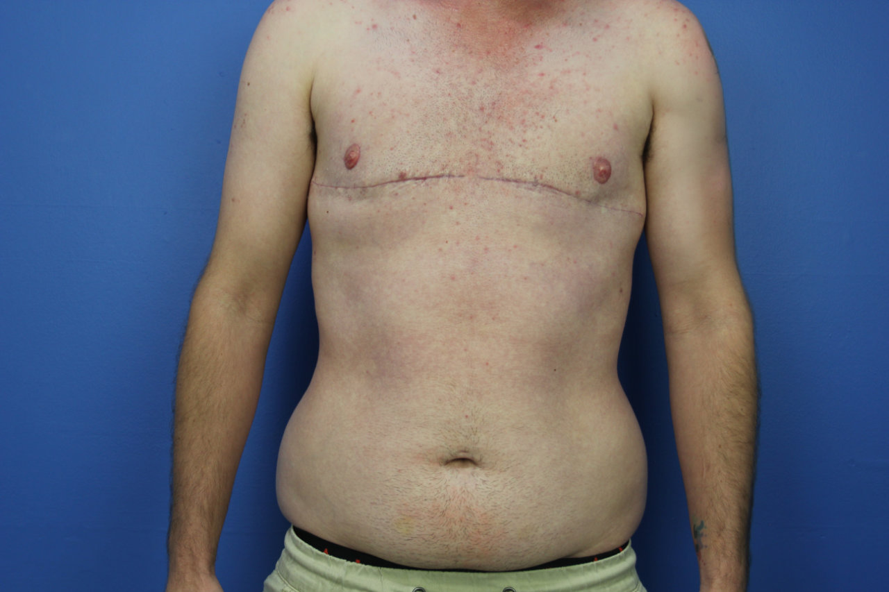 Chest anterior
